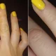 Disyhdrotic eczema