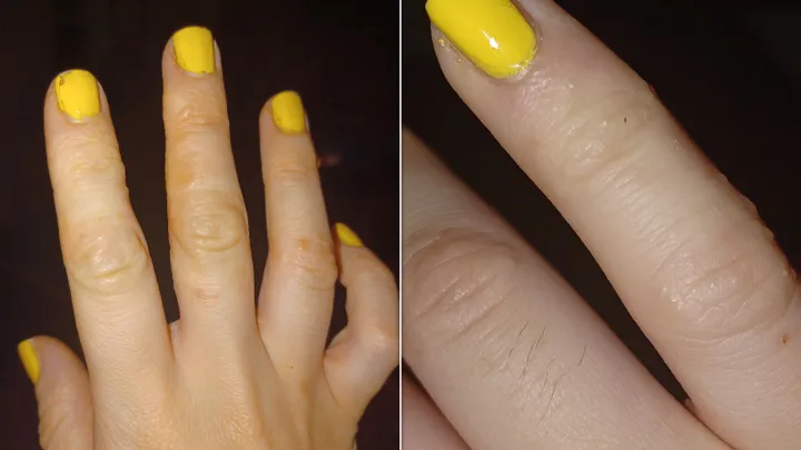 Disyhdrotic eczema