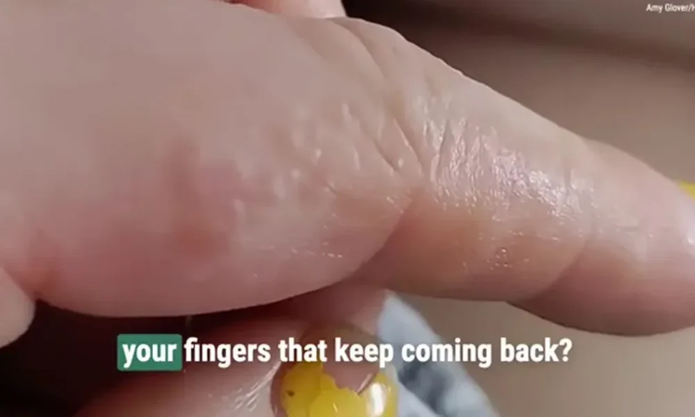 Do you ever get tiny itchy bumps on your fingers?