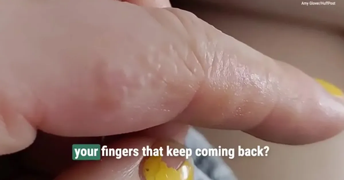 Do you ever get tiny itchy bumps on your fingers?