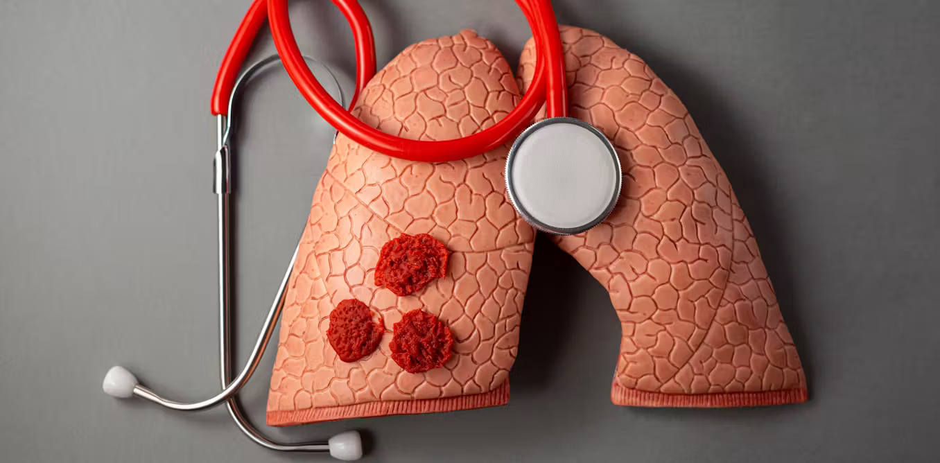 Hundreds of people in England have died before doctors diagnosed their tuberculosis