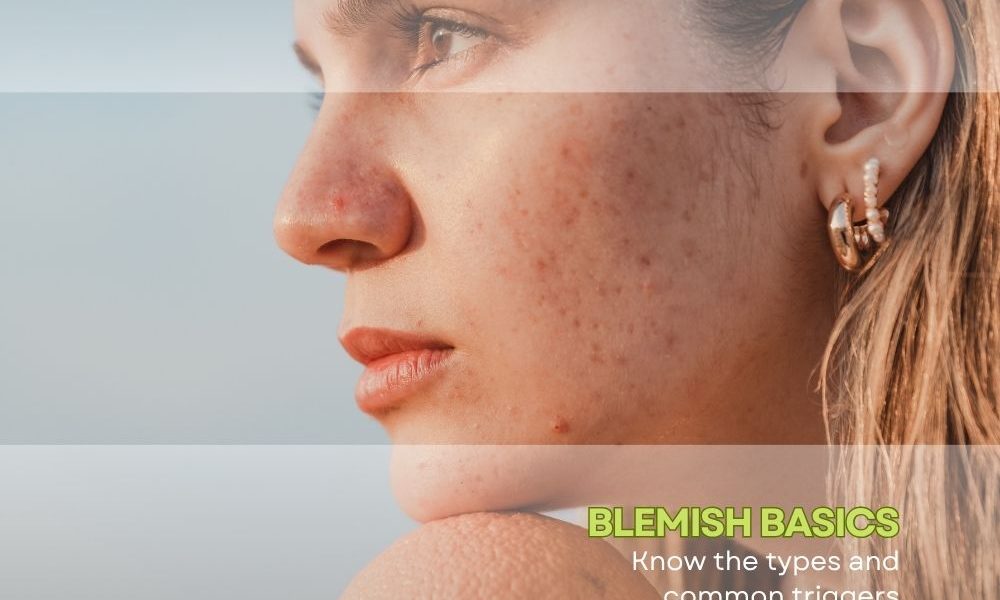 How to get ride of acne blemishes