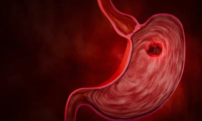 Gastric cancer. Noncommunicable diseases or NCDs. Gastrointestinal ailments from eating junk food. Stomach pain, stomach ulcers from acid reflux. 3D Rendering
