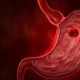 Gastric cancer. Noncommunicable diseases or NCDs. Gastrointestinal ailments from eating junk food. Stomach pain, stomach ulcers from acid reflux. 3D Rendering