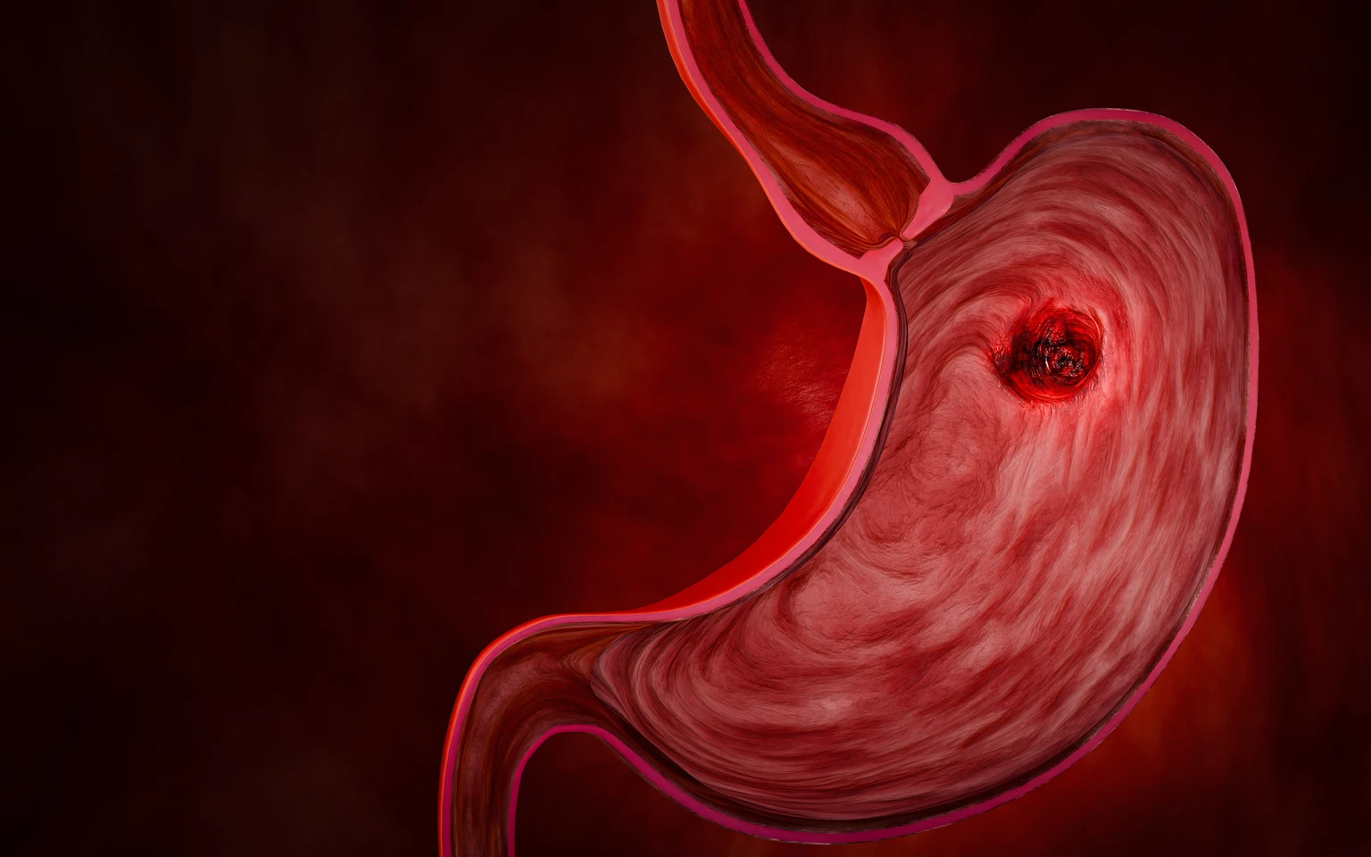 Gastric cancer. Noncommunicable diseases or NCDs. Gastrointestinal ailments from eating junk food. Stomach pain, stomach ulcers from acid reflux. 3D Rendering