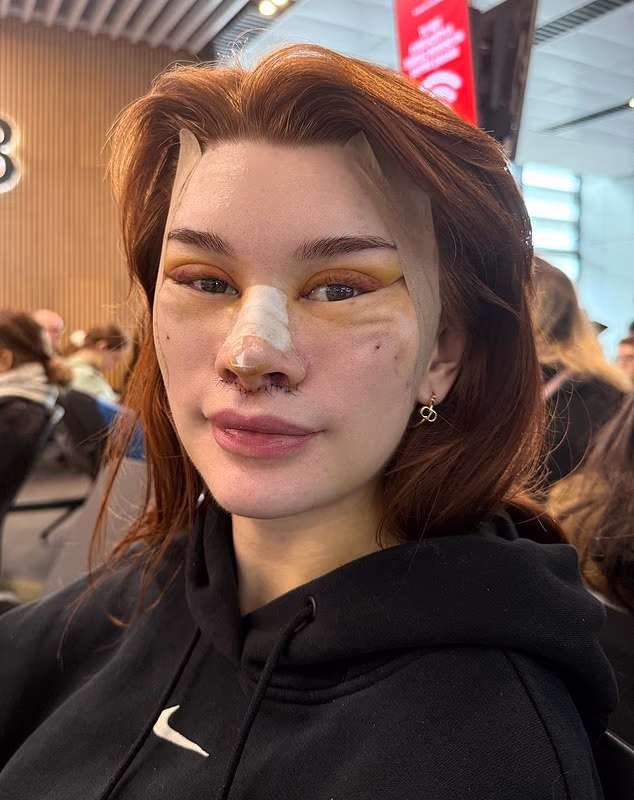 After having a full facelift in March, Antonia Higham suffered weeks of swelling, which still hasn't fully gone down