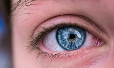 What Is 'Ferritin Face'? Signs Of Iron Deficiency Explained
