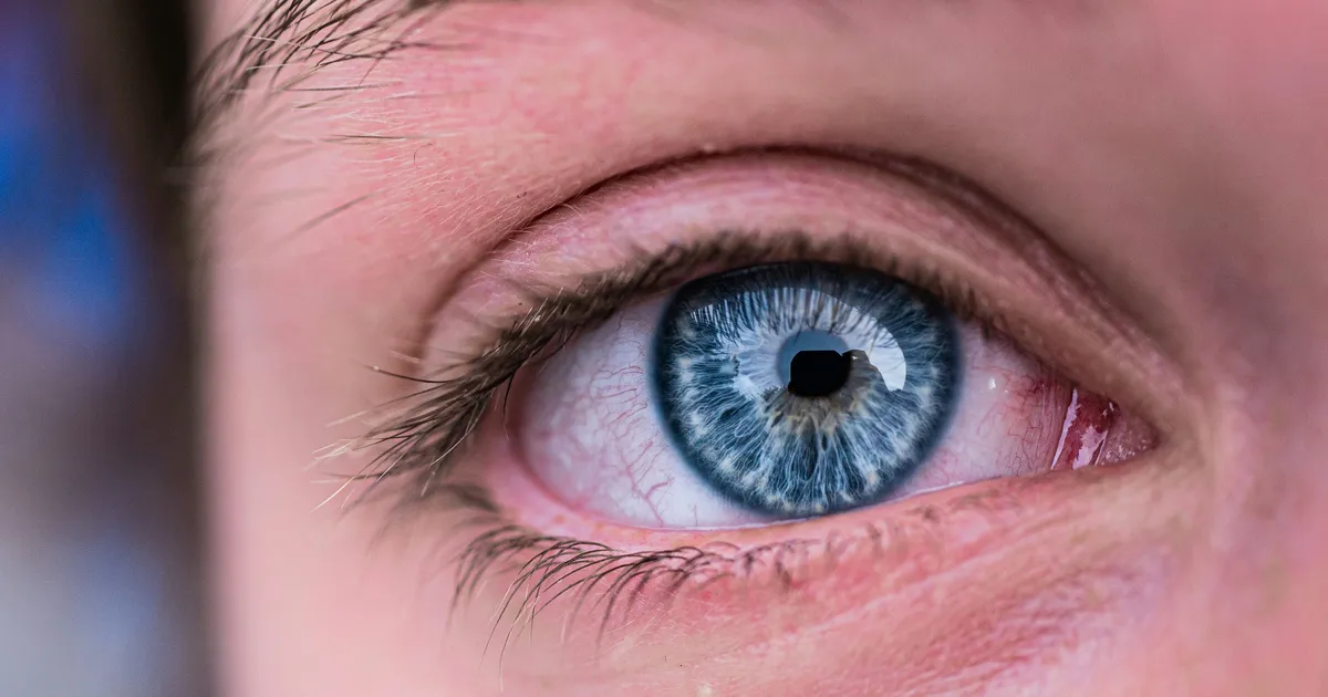What Is 'Ferritin Face'? Signs Of Iron Deficiency Explained