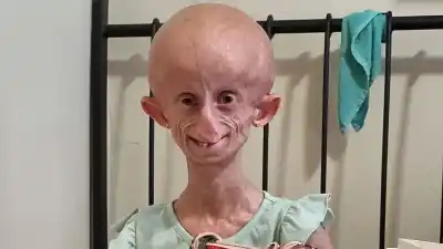 TikTok Star Beandri Booysen Dies at 19 From Rare Aging Disease