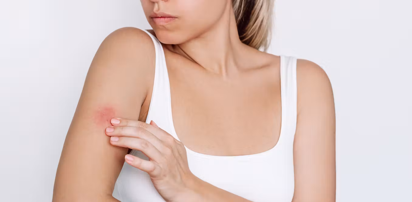 Why do some people react so badly to mosquito bites? The answer lies in mosquito saliva