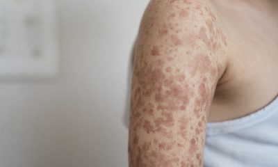 10 Simple Ways to Prevent Measles Infection as US Cases