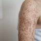 10 Simple Ways to Prevent Measles Infection as US Cases