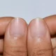 Non-reddened lunulae
