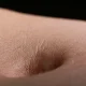 Bellybutton Smell May Show Parkinson's Or Cognitive Decline