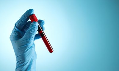 Who Should Get a Blood Test for Alzheimer's Disease?