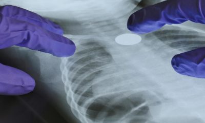 A Genetic Mutation May Help Explain Lung Cancer in Nonsmokers