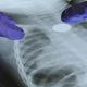 A Genetic Mutation May Help Explain Lung Cancer in Nonsmokers