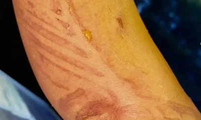 Nicole Scherzinger Shares Gruesome Pic After ‘Boiling’ Water Fell on Her Leg: ‘Show Must Go On’