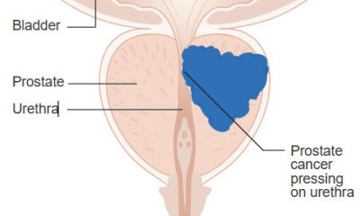 Doctor Explains How Prostate Cancer Screening And Treatment Have Evolved