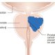 Doctor Explains How Prostate Cancer Screening And Treatment Have Evolved