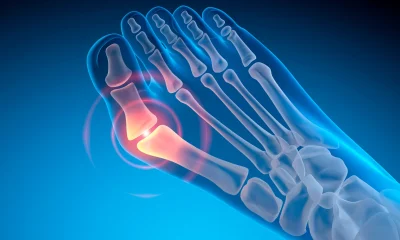 Bunion - Valgus deformity of the big toe
