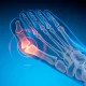 Bunion - Valgus deformity of the big toe