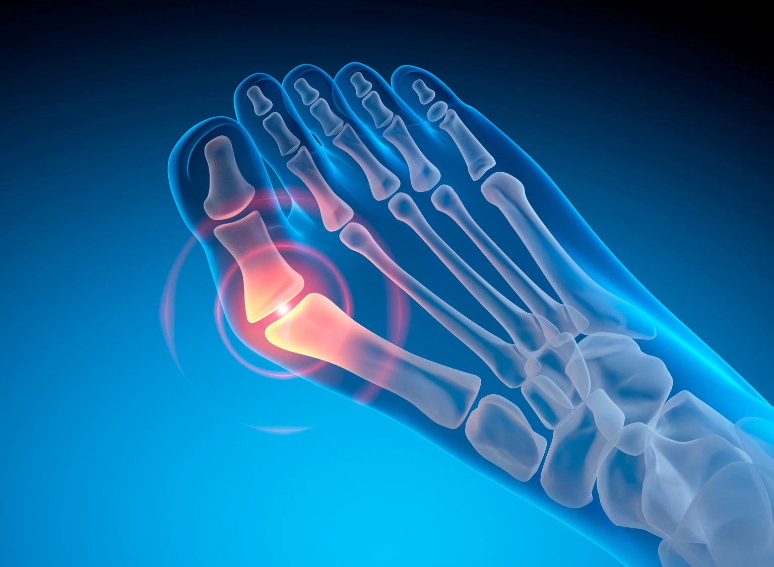 Bunion - Valgus deformity of the big toe