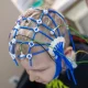 Xenon: Epilepsy Got It To $59; Depression Has To Take It From Here (NASDAQ:XENE)