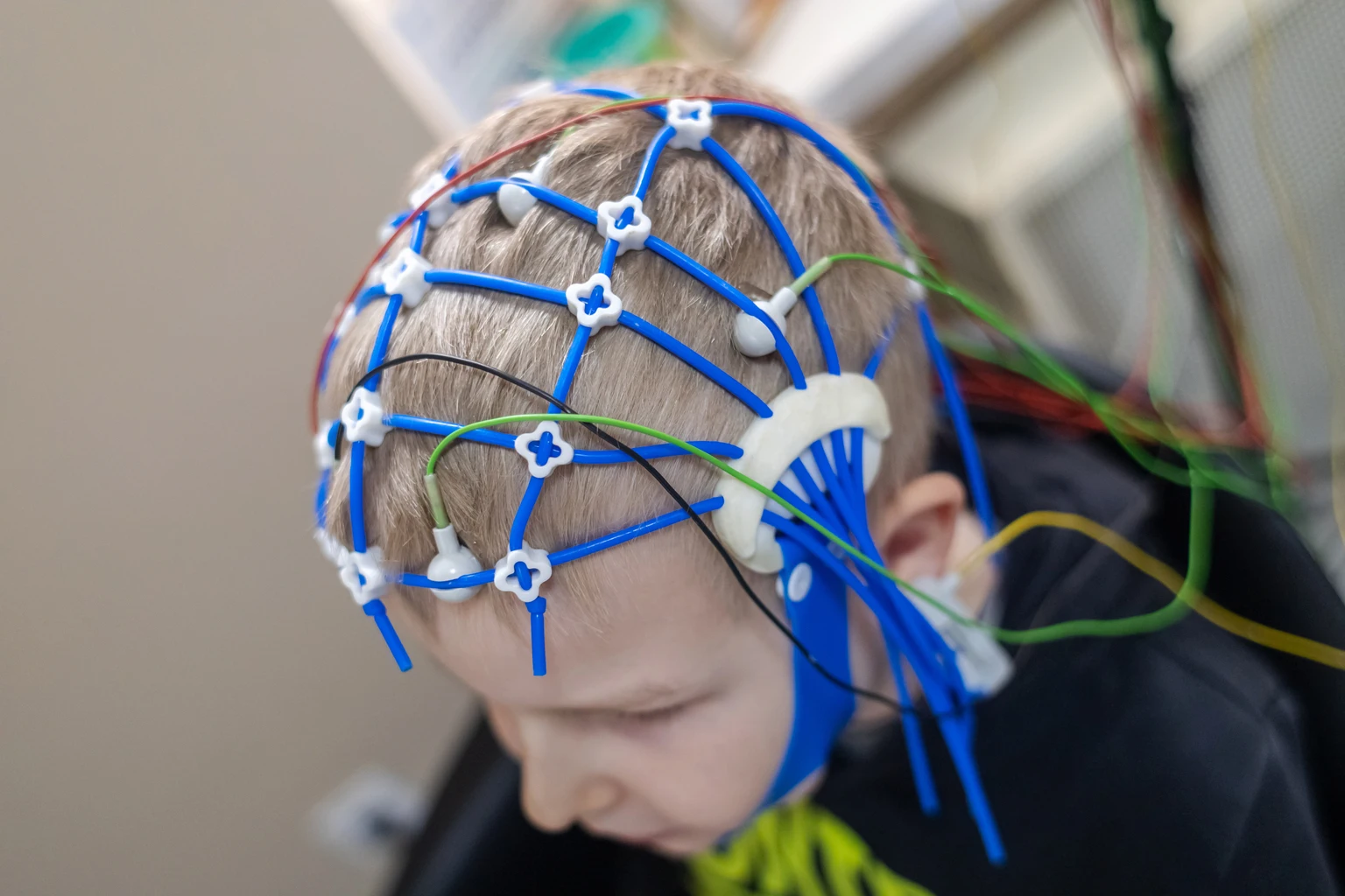 Xenon: Epilepsy Got It To $59; Depression Has To Take It From Here (NASDAQ:XENE)
