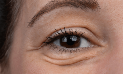 What Causes Bags Under Your Eyes? Main Causes and Treatments