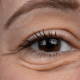 What Causes Bags Under Your Eyes? Main Causes and Treatments