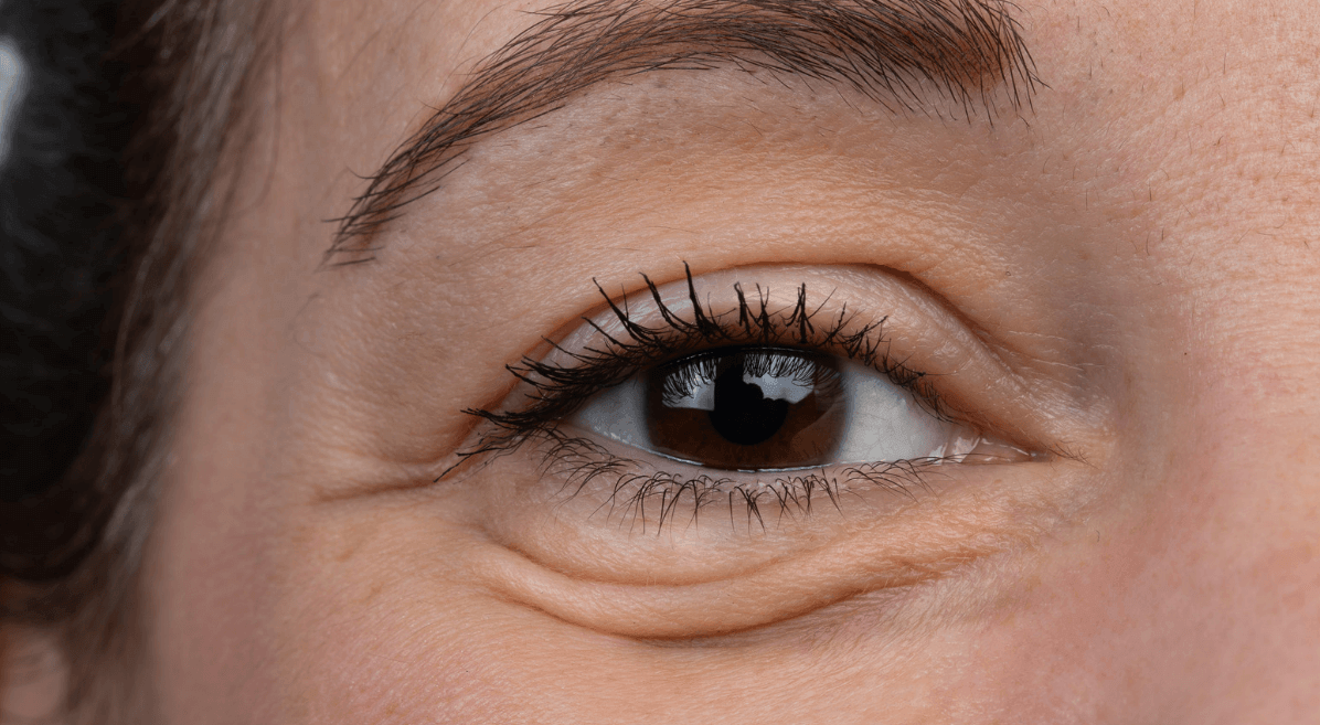 What Causes Bags Under Your Eyes? Main Causes and Treatments
