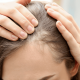 Hairline Transplant: Procedure, Cost, Recovery, and Results
