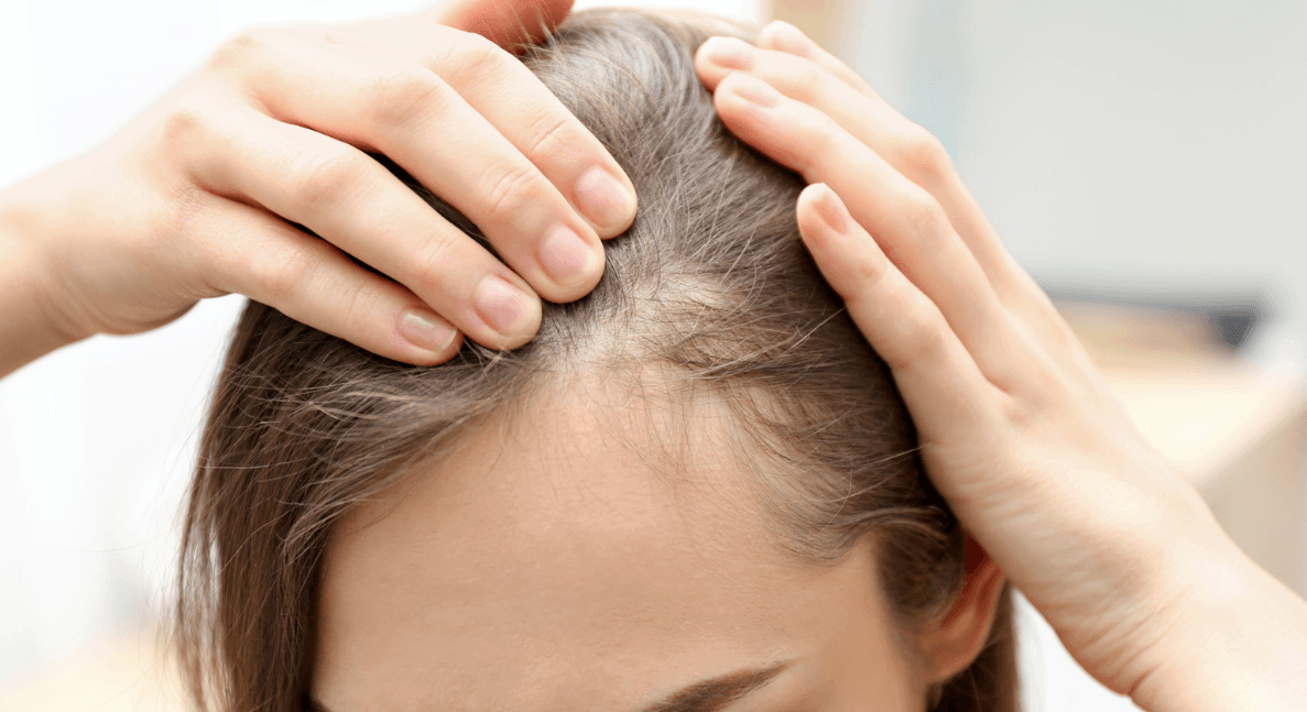Hairline Transplant: Procedure, Cost, Recovery, and Results